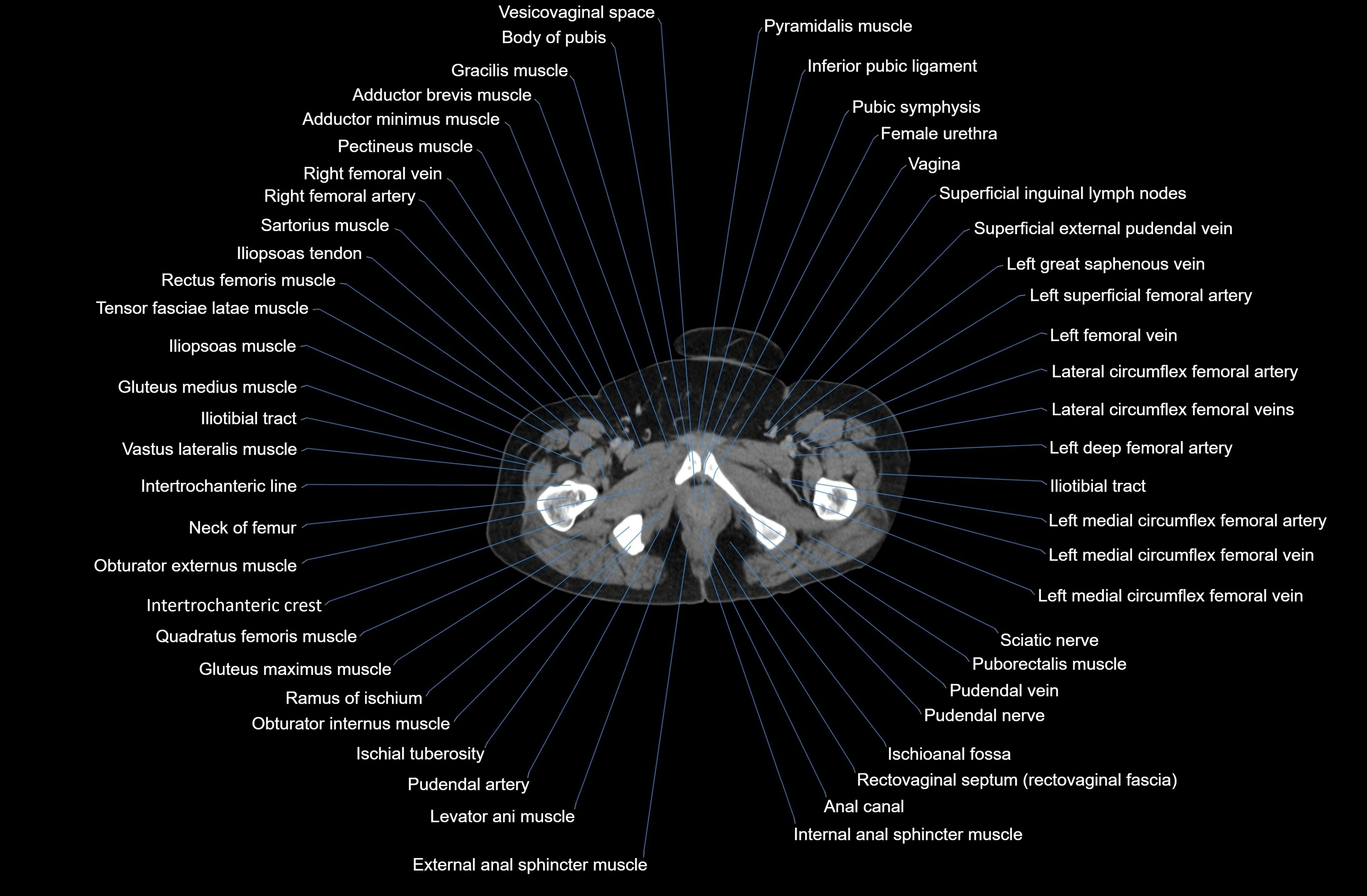 CT Abdomen axial cross sectional anatomy labelled radiology image-00101.webp